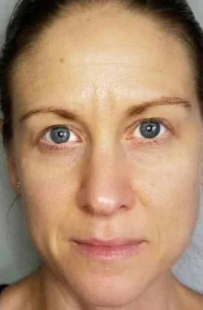 Simpla 360 hat dazu beigetragen, die Haut zu verjüngen und die Flecken aufzuhellen
